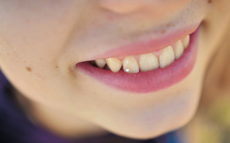 Biały diamencik na zębie