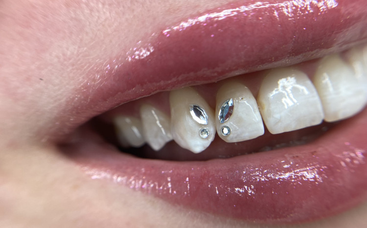 Ozdoby na białych zębach