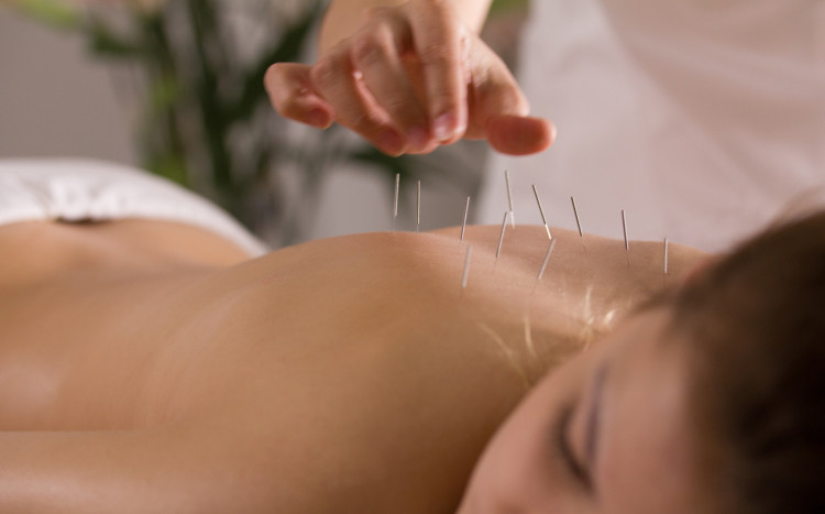 akupunktura pleców