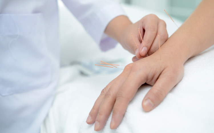 akupunktura dłoni