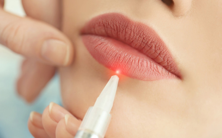laserowa korekcja ust