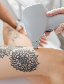 Voucher na laserowe usuwanie tatuażu – Łódź