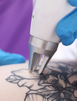 Laserowe usuwanie tatuażu - Łódź